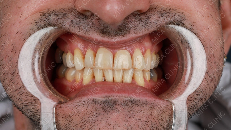 Hollywood smile make over Before - patient reviews 